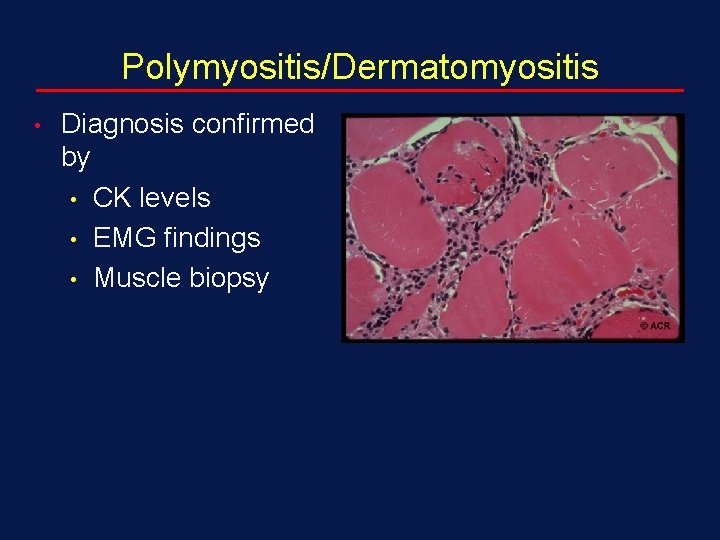 Polymyositis/Dermatomyositis • Diagnosis confirmed by • CK levels • EMG findings • Muscle biopsy