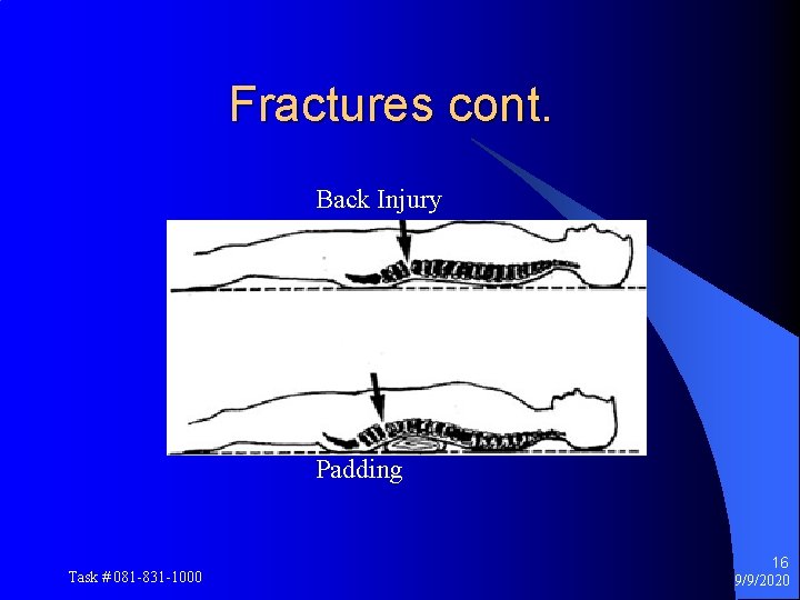 Fractures cont. Back Injury Padding Task # 081 -831 -1000 16 9/9/2020 