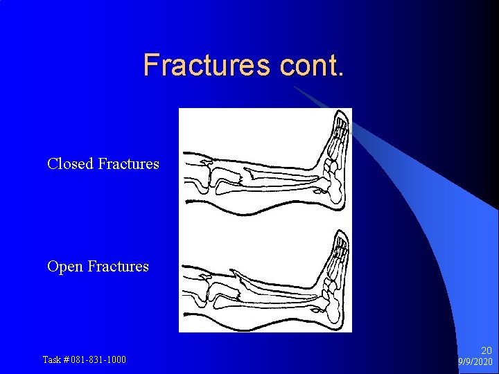 Fractures cont. Closed Fractures Open Fractures Task # 081 -831 -1000 20 9/9/2020 
