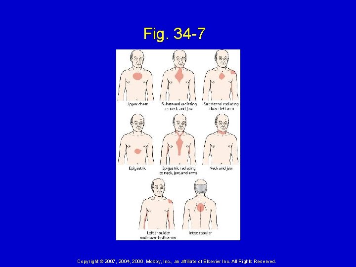 Fig. 34 -7 Copyright © 2007, 2004, 2000, Mosby, Inc. , an affiliate of