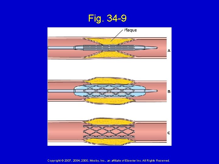 Fig. 34 -9 Copyright © 2007, 2004, 2000, Mosby, Inc. , an affiliate of