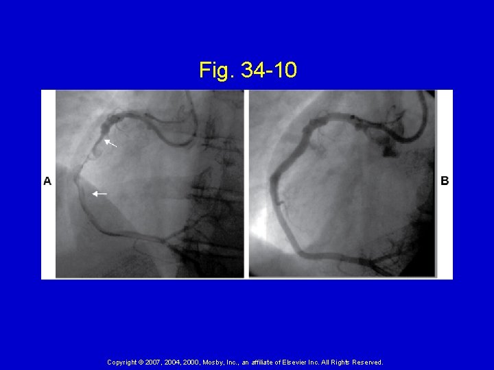 Fig. 34 -10 Copyright © 2007, 2004, 2000, Mosby, Inc. , an affiliate of