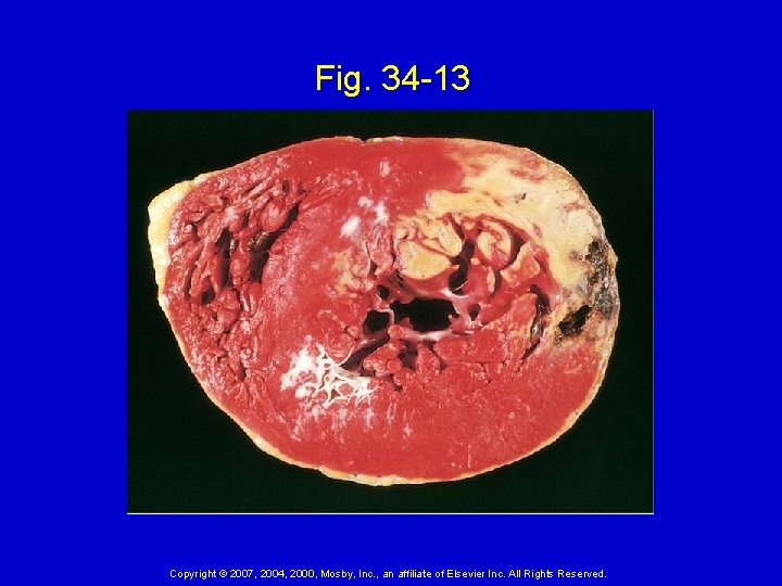 Fig. 34 -13 Copyright © 2007, 2004, 2000, Mosby, Inc. , an affiliate of