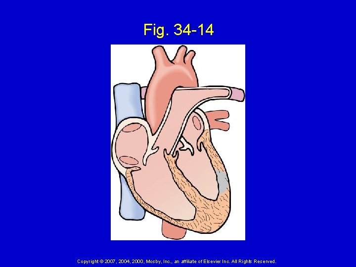 Fig. 34 -14 Copyright © 2007, 2004, 2000, Mosby, Inc. , an affiliate of