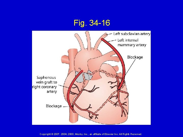 Fig. 34 -16 Copyright © 2007, 2004, 2000, Mosby, Inc. , an affiliate of