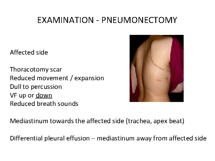 EXAMINATION - PNEUMONECTOMY Affected side Thoracotomy scar Reduced movement / expansion Dull to percussion