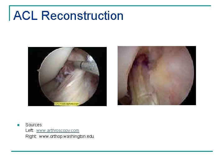 ACL Reconstruction n Sources: Left: www. arthroscopy. com Right: www. orthop. washington. edu 