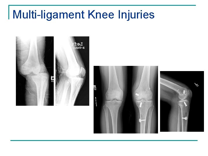 Multi-ligament Knee Injuries 