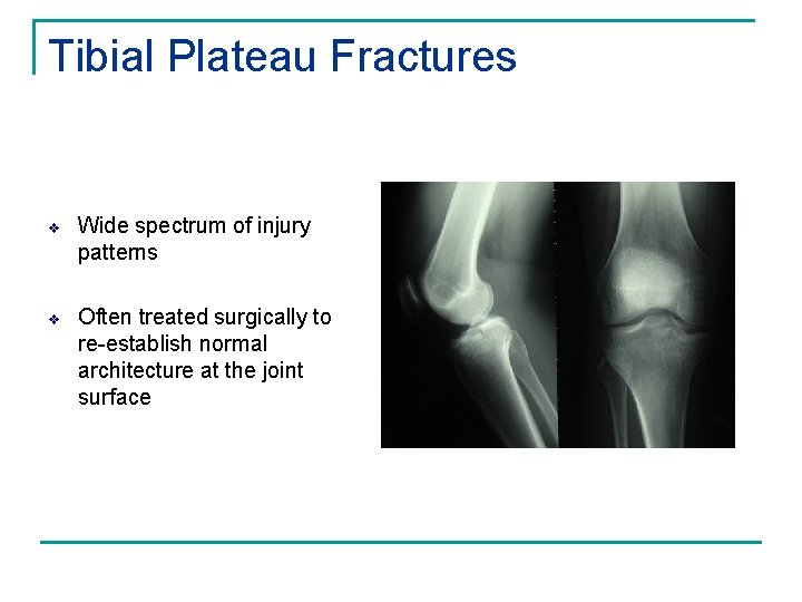 Tibial Plateau Fractures v Wide spectrum of injury patterns v Often treated surgically to
