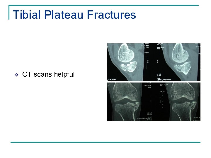 Tibial Plateau Fractures v CT scans helpful 
