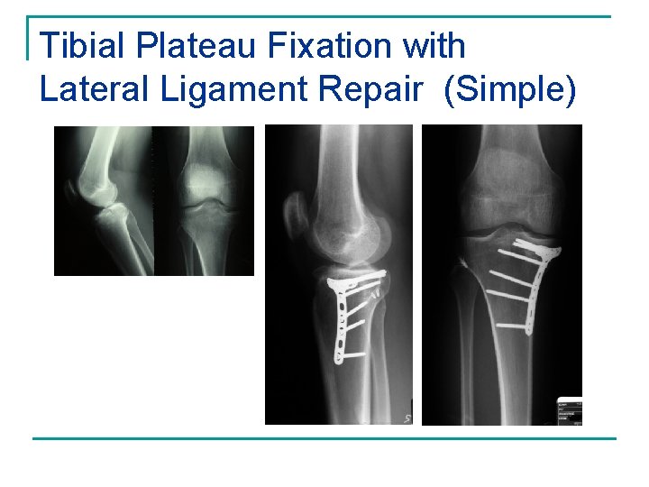 Tibial Plateau Fixation with Lateral Ligament Repair (Simple) 