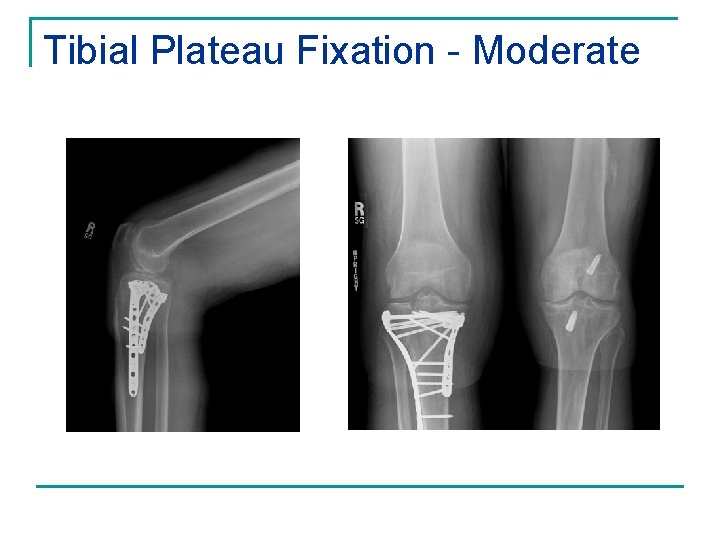 Tibial Plateau Fixation - Moderate 
