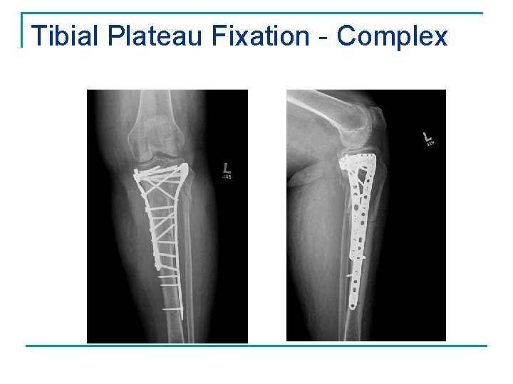 Tibial Plateau Fixation - Complex 