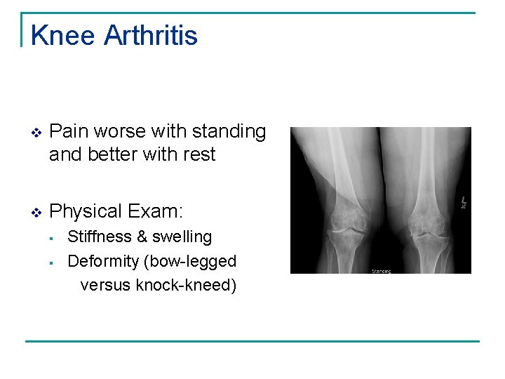Knee Arthritis v Pain worse with standing and better with rest v Physical Exam: