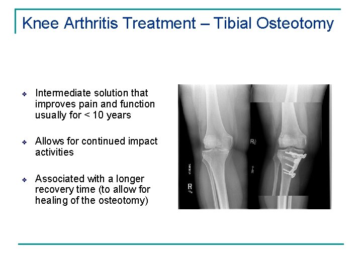 Knee Arthritis Treatment – Tibial Osteotomy v Intermediate solution that improves pain and function