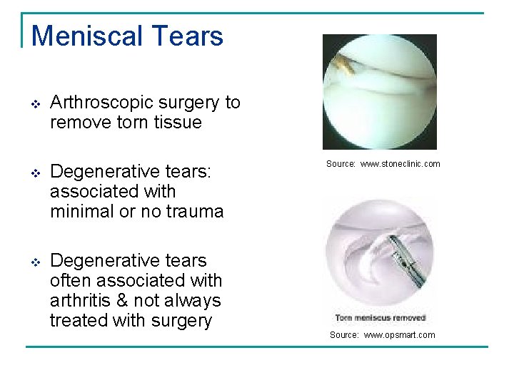 Meniscal Tears v Arthroscopic surgery to remove torn tissue v Degenerative tears: associated with