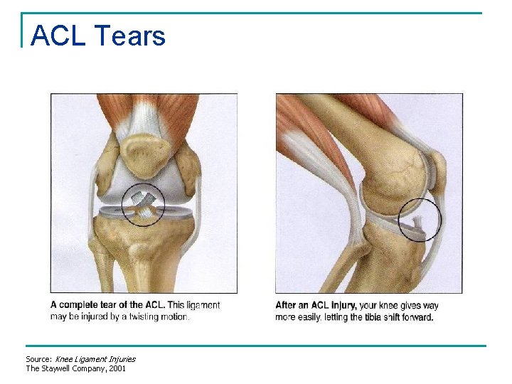 ACL Tears Source: Knee Ligament Injuries The Staywell Company, 2001 