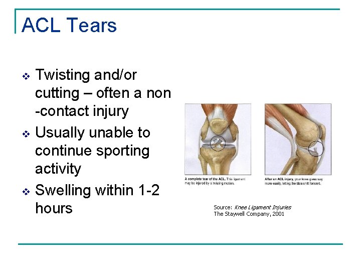 ACL Tears v v v Twisting and/or cutting – often a non -contact injury