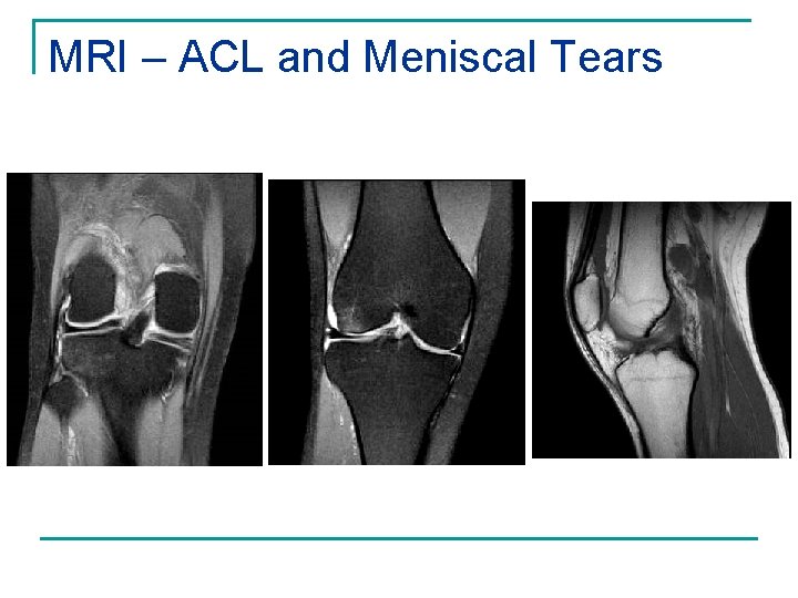 MRI – ACL and Meniscal Tears 