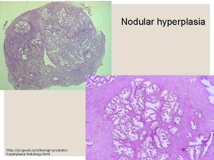 Nodular hyperplasia http: //pixgood. com/benign-prostatichyperplasia-histology. html 