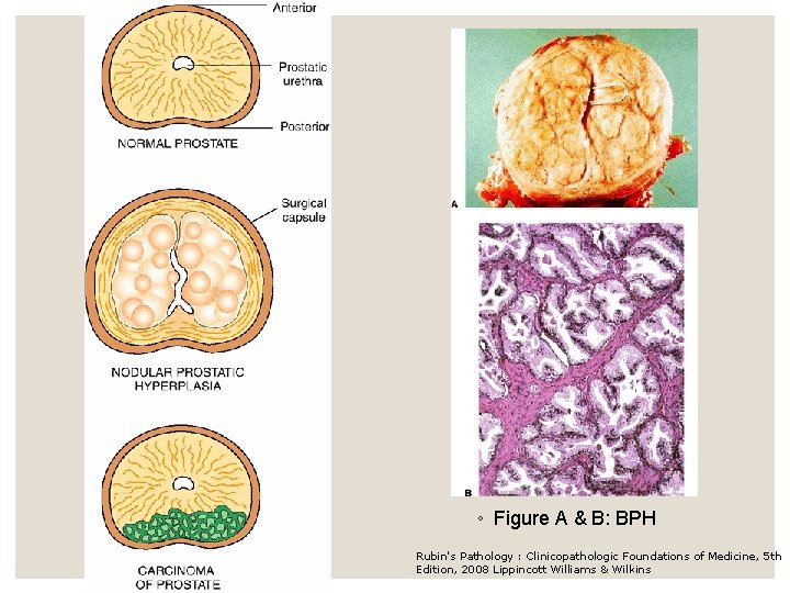 ◦ Figure A & B: BPH Rubin's Pathology : Clinicopathologic Foundations of Medicine, 5