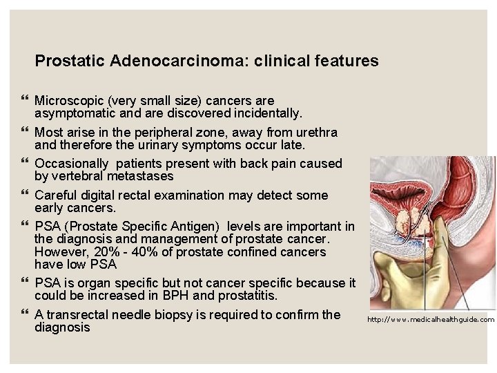 Prostatic Adenocarcinoma: clinical features Microscopic (very small size) cancers are asymptomatic and are discovered