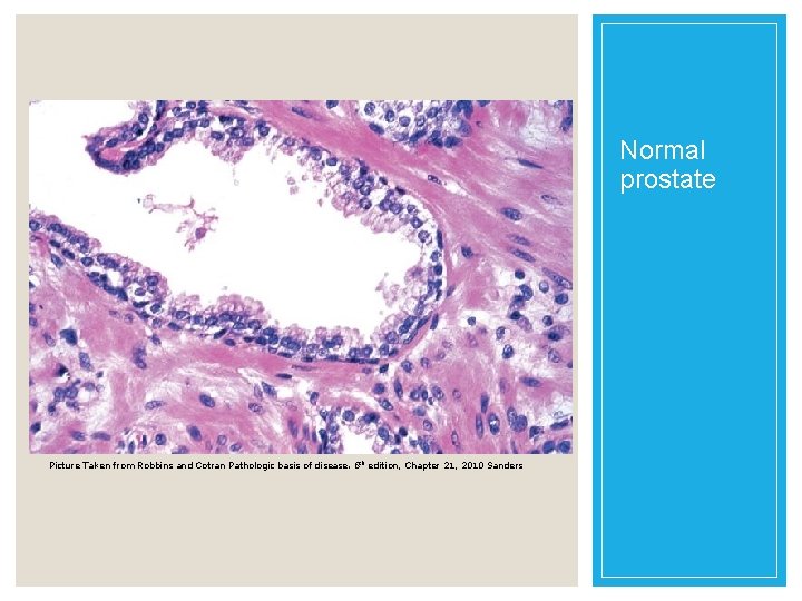 Normal prostate Picture Taken from Robbins and Cotran Pathologic basis of disease. 8 th