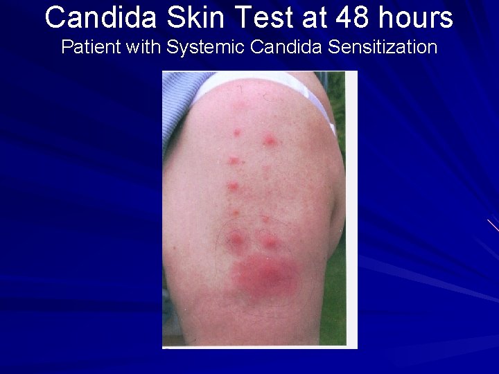 Candida Skin Test at 48 hours Patient with Systemic Candida Sensitization 