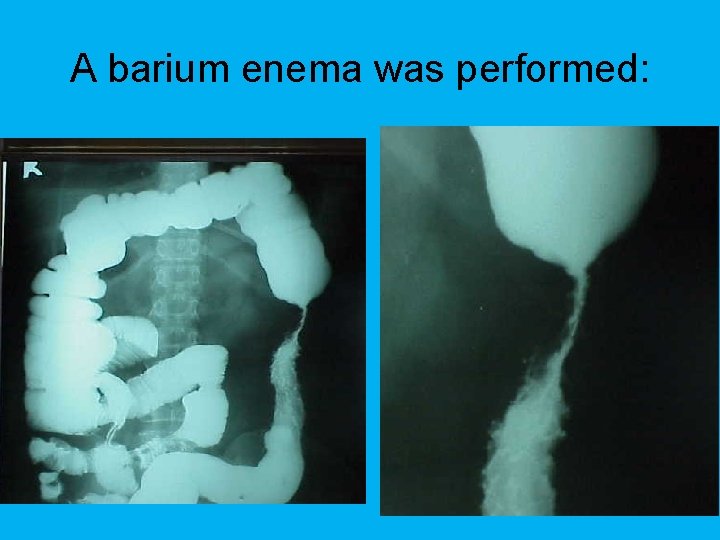 A barium enema was performed: 