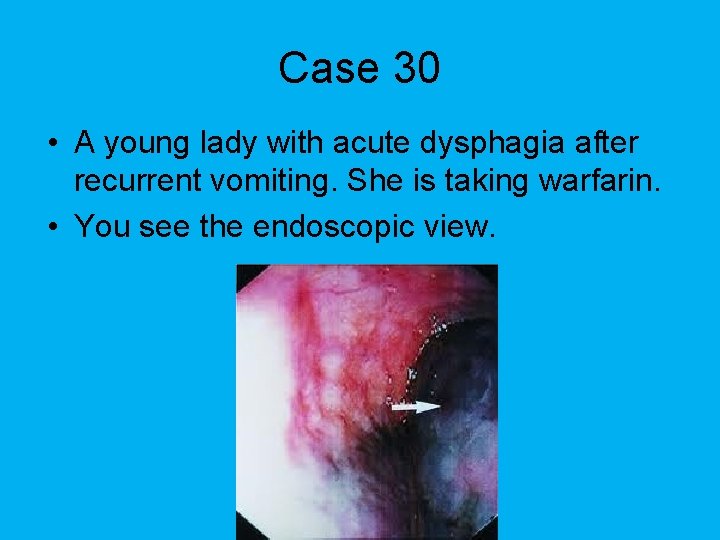 Case 30 • A young lady with acute dysphagia after recurrent vomiting. She is