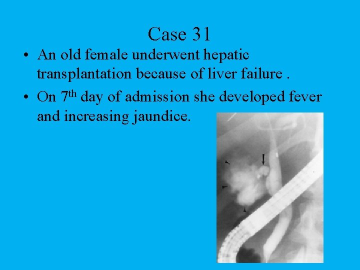 Case 31 • An old female underwent hepatic transplantation because of liver failure. •