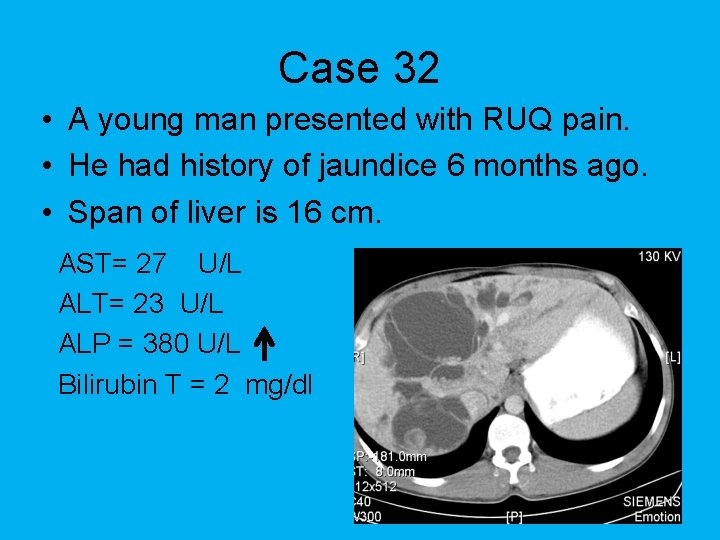 Case 32 • A young man presented with RUQ pain. • He had history
