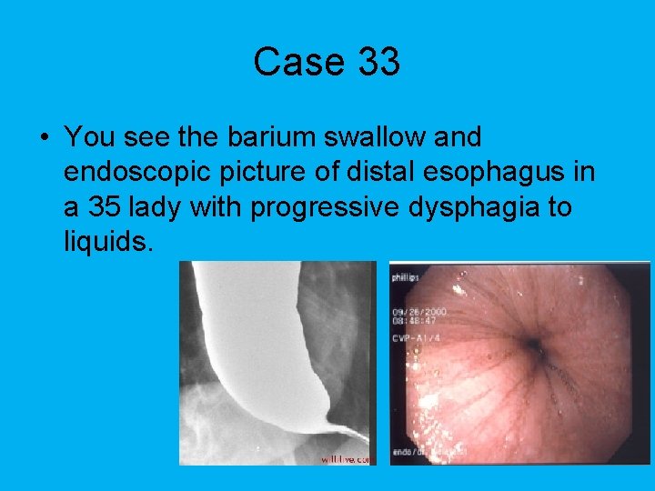 Case 33 • You see the barium swallow and endoscopic picture of distal esophagus