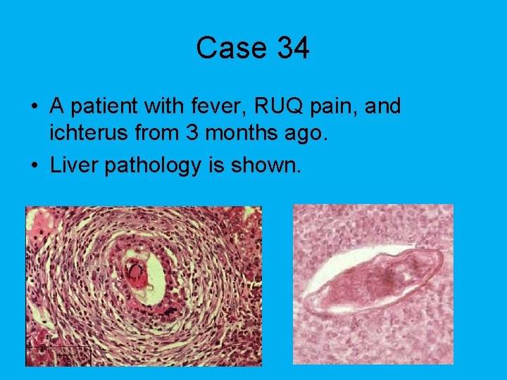 Case 34 • A patient with fever, RUQ pain, and ichterus from 3 months