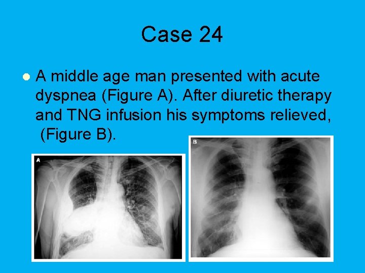 Case 24 l A middle age man presented with acute dyspnea (Figure A). After