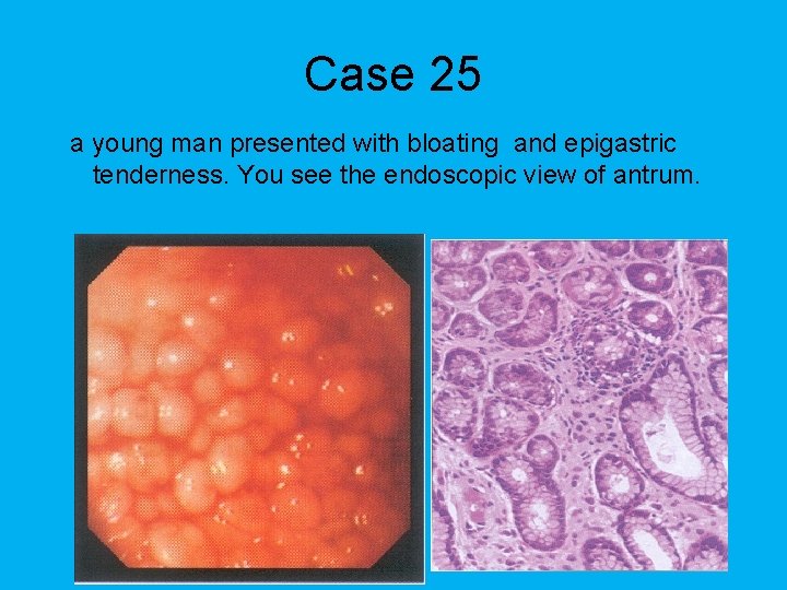 Case 25 a young man presented with bloating and epigastric tenderness. You see the