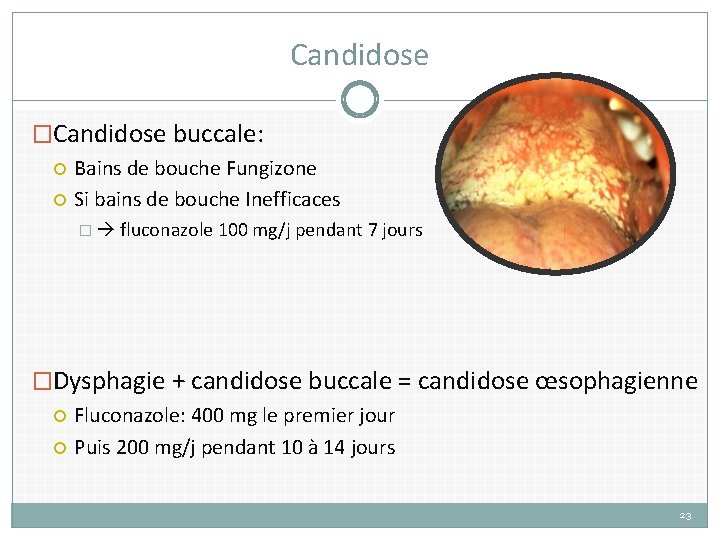 Candidose �Candidose buccale: Bains de bouche Fungizone Si bains de bouche Inefficaces � fluconazole