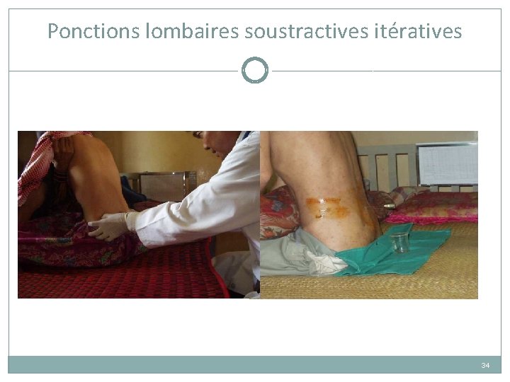 Ponctions lombaires soustractives itératives 34 