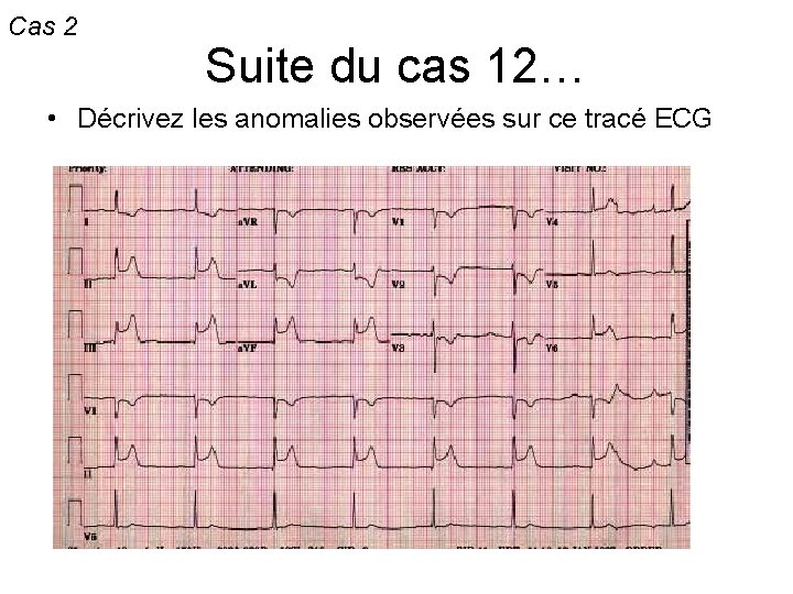 Cas 2 Suite du cas 12… • Décrivez les anomalies observées sur ce tracé