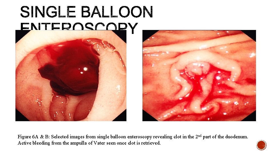 Figure 6 A & B: Selected images from single balloon enteroscopy revealing clot in
