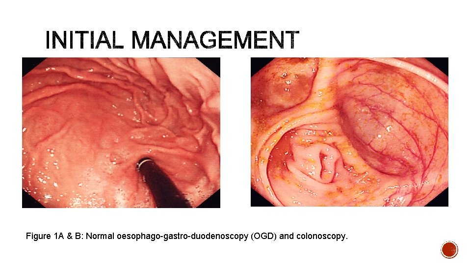 Figure 1 A & B: Normal oesophago-gastro-duodenoscopy (OGD) and colonoscopy. 