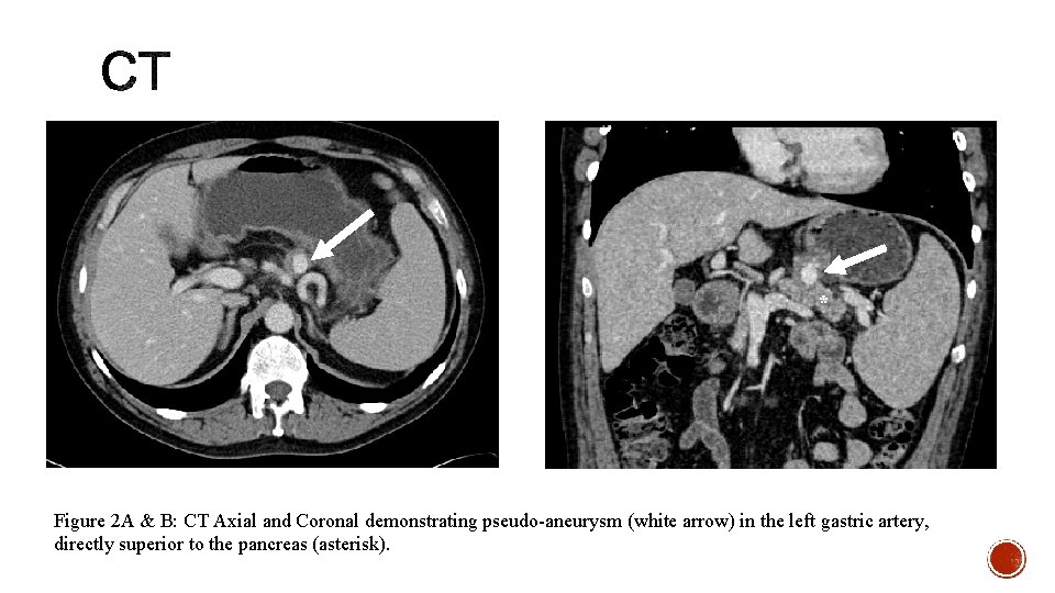 * Figure 2 A & B: CT Axial and Coronal demonstrating pseudo-aneurysm (white arrow)