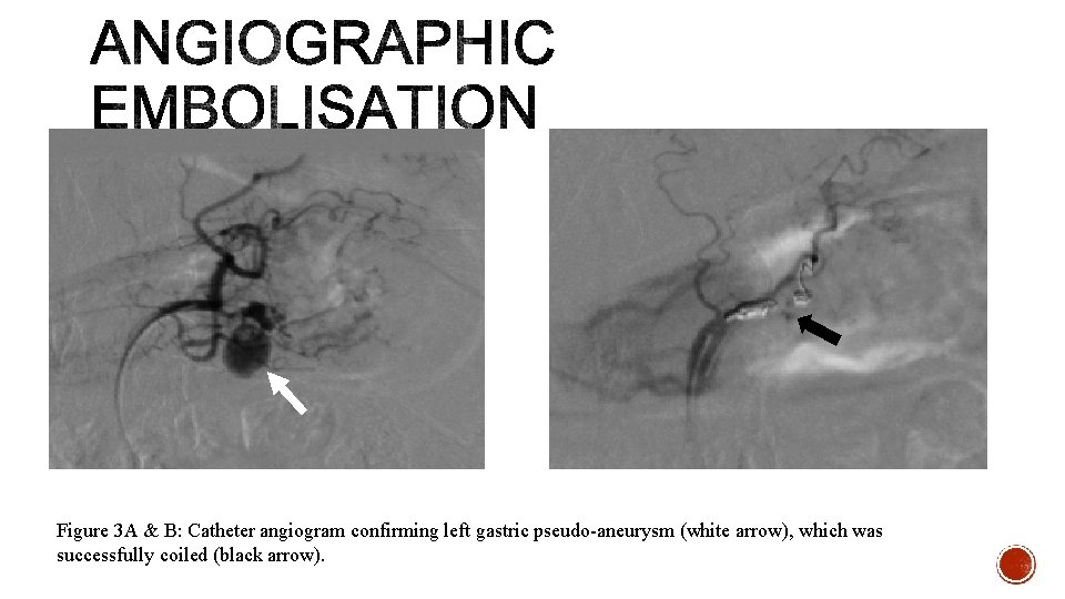 Figure 3 A & B: Catheter angiogram confirming left gastric pseudo-aneurysm (white arrow), which