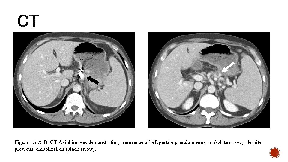 Figure 4 A & B: CT Axial images demonstrating recurrence of left gastric pseudo-aneurysm