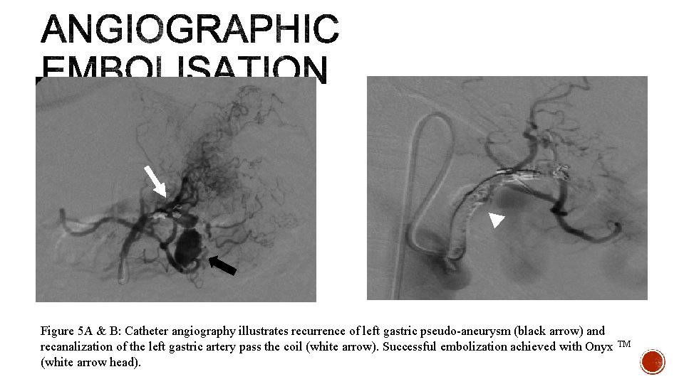 Figure 5 A & B: Catheter angiography illustrates recurrence of left gastric pseudo-aneurysm (black