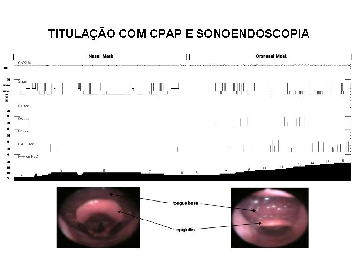 TITULAÇÃO COM CPAP E SONOENDOSCOPIA 