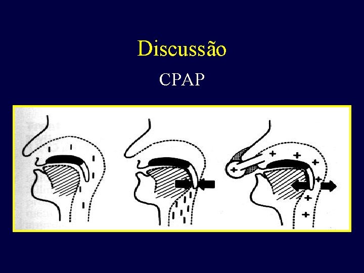 Discussão CPAP 