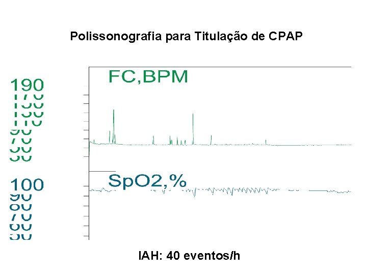 Polissonografia para Titulação de CPAP HIPNOGRAMA NOTURNO IAH: 40 eventos/h 
