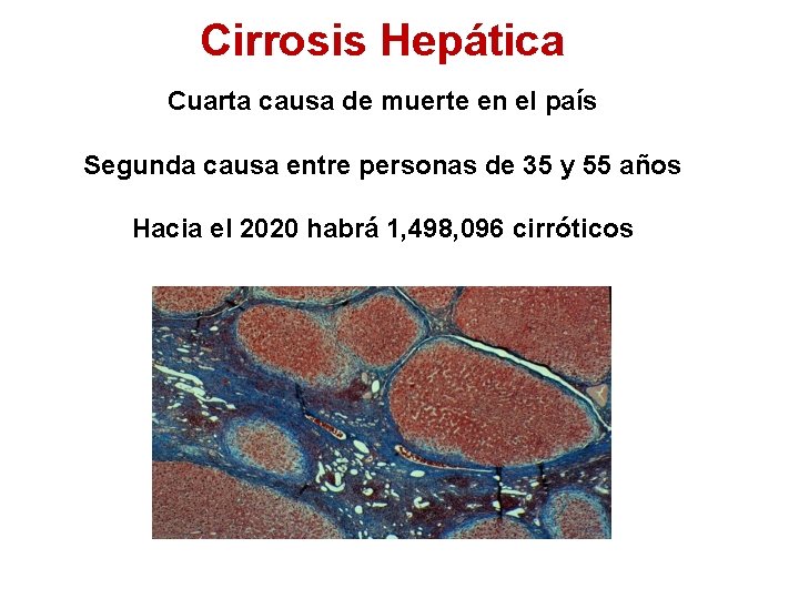 Cirrosis Hepática Cuarta causa de muerte en el país Segunda causa entre personas de