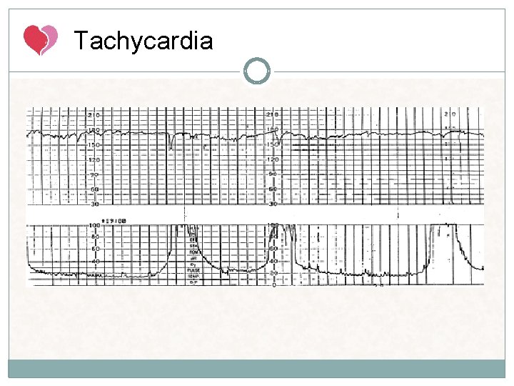 Tachycardia Tachycardia